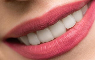 Lip Filler